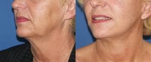 Le lifting cervico-facial, remodelant cou et joue