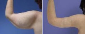 Lifting + Liposculpture des bras