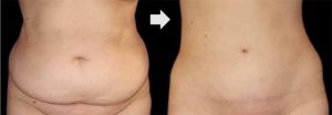 Lifting abdominal et plastie abdominale