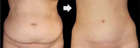 Abdominoplastie Tunisie