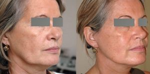 Lifting complet du visage