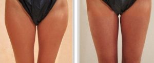 Liposuccion des faces internes et externes des cuisses